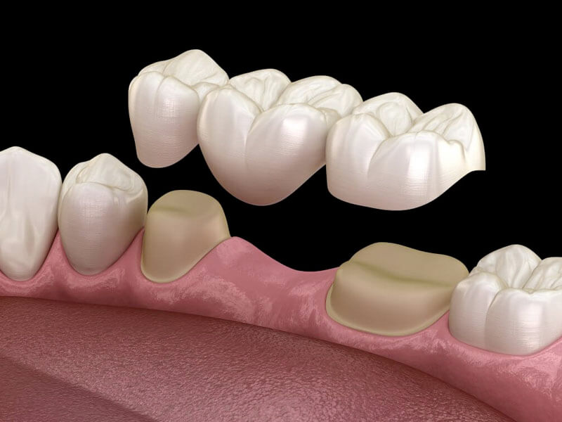 dental crowns Kellyville Ridge