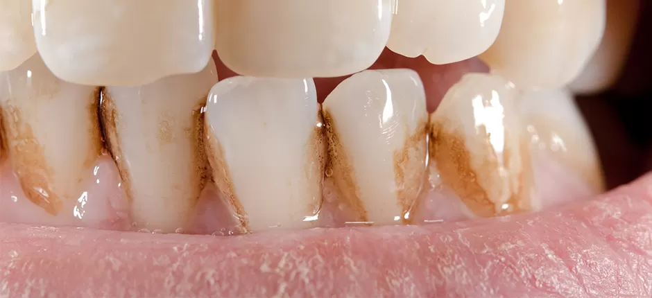 Teeth Staining: Causes, Prevention & Treatment