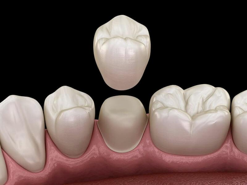 dental bridges Kellyville Ridge